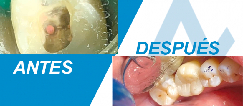 Caso tratado: Endodoncia Mecanizada