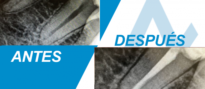 Caso tratado: endodoncia