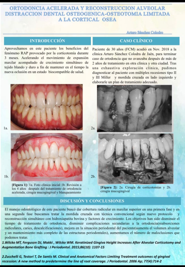 Ortodoncia acelerada y construcción alveolar mediante distracción osteogénica · El proceso 1