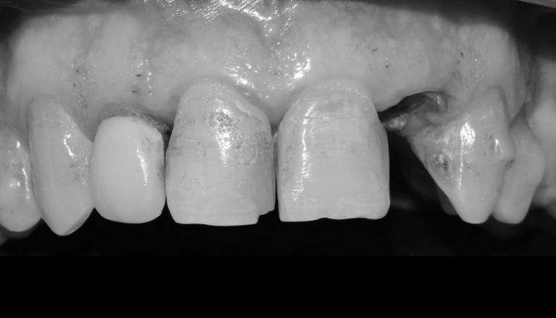 Implantes inmediatos postextracción en posiciones 12 y 22 · El proceso 1