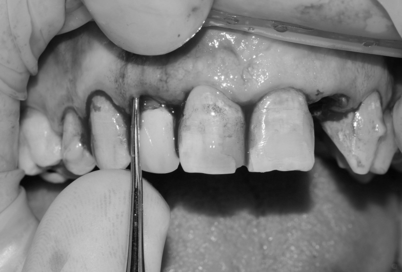 Implantes inmediatos postextracción en posiciones 12 y 22 · El proceso 2