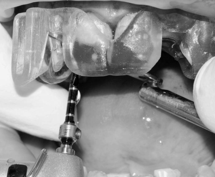 Implantes inmediatos postextracción en posiciones 12 y 22 · El proceso 3