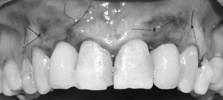 Implantes inmediatos postextracción en posiciones 12 y 22 · El proceso 5