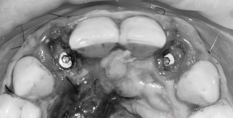 Implantes inmediatos postextracción en posiciones 12 y 22 · El proceso 4