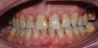 La transformación de una sonrisa con carillas cerámicas y blanqueamiento combinado · Antes