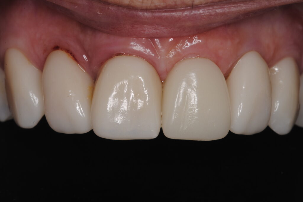 Cirugía guiada: transformación dental en un solo día · El proceso 3