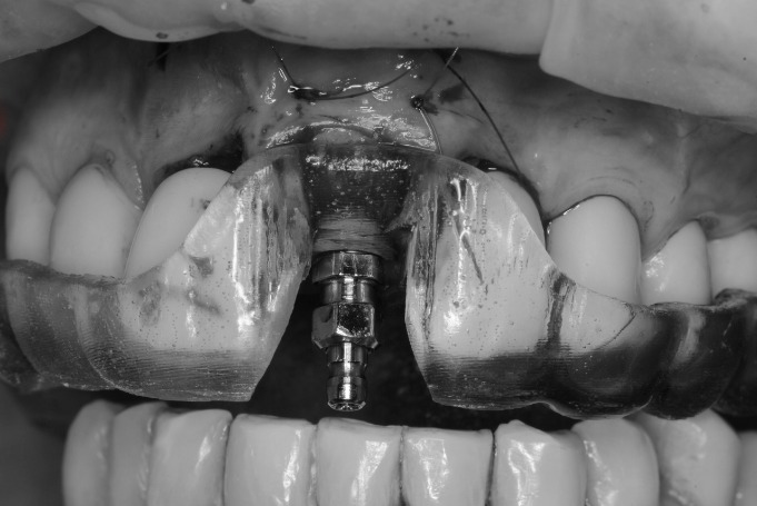 Cirugía guiada: transformación dental en un solo día · El proceso 4