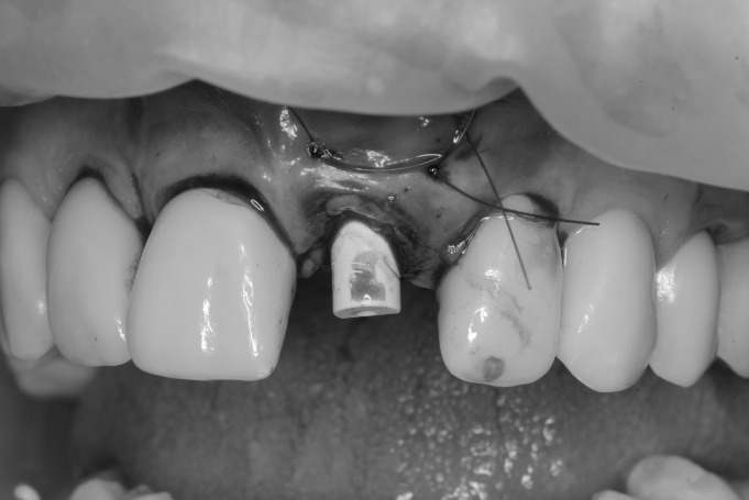 Cirugía guiada: transformación dental en un solo día · El proceso 1