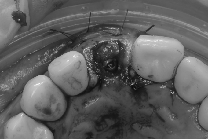 Cirugía guiada: transformación dental en un solo día · El proceso 2