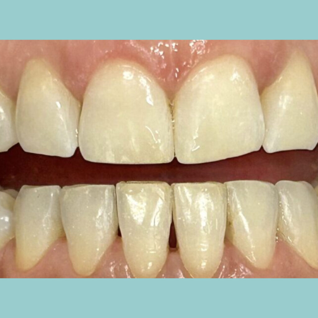 Renovación estética con composite cerámico · Antes