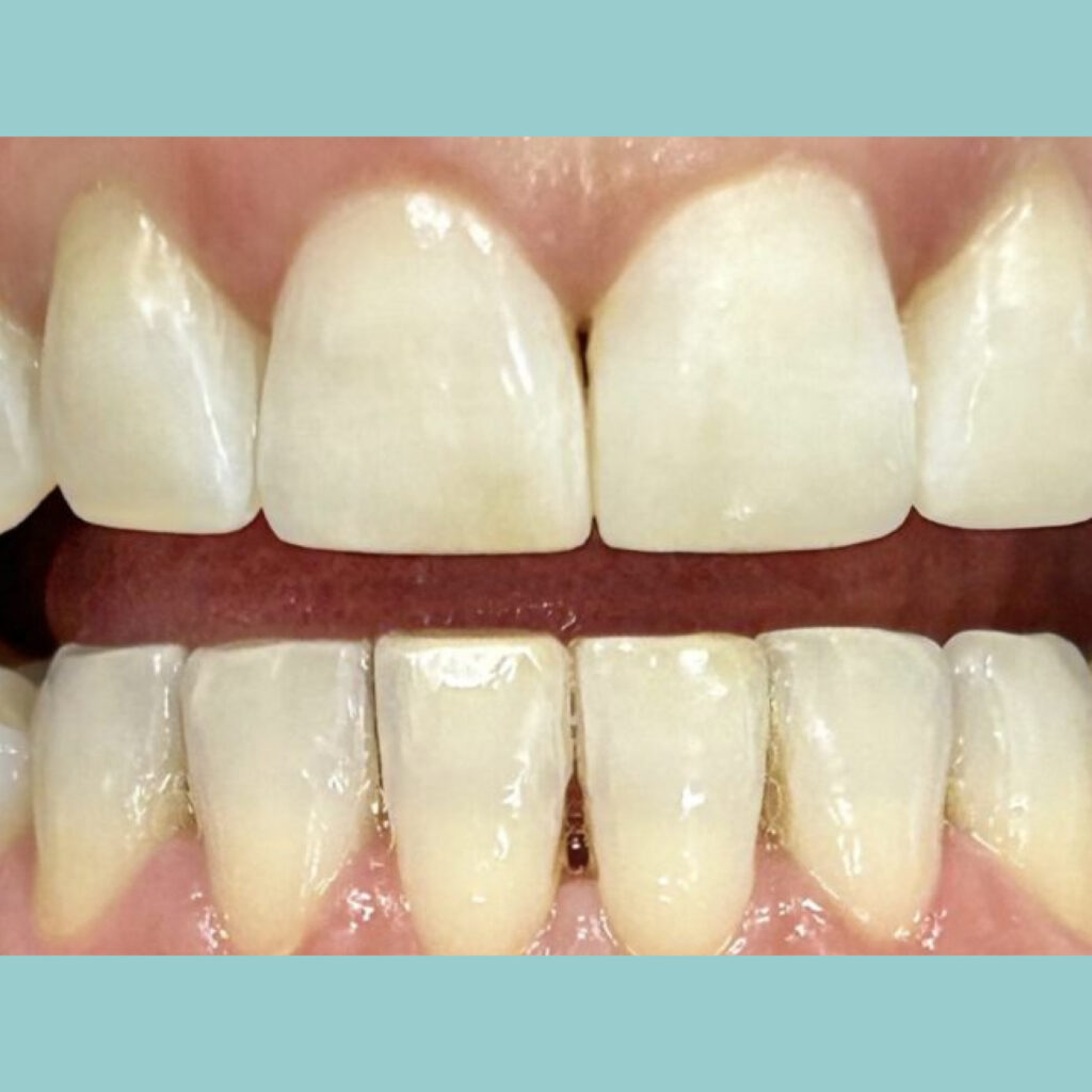 Renovación estética con composite cerámico · Después