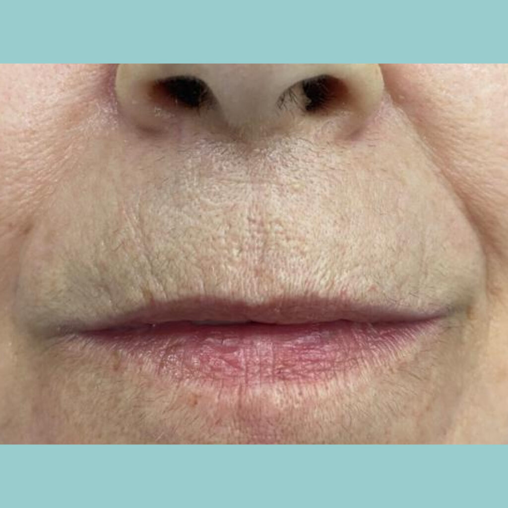 Transformación estética y rejuvenecimiento de la sonrisa · Antes