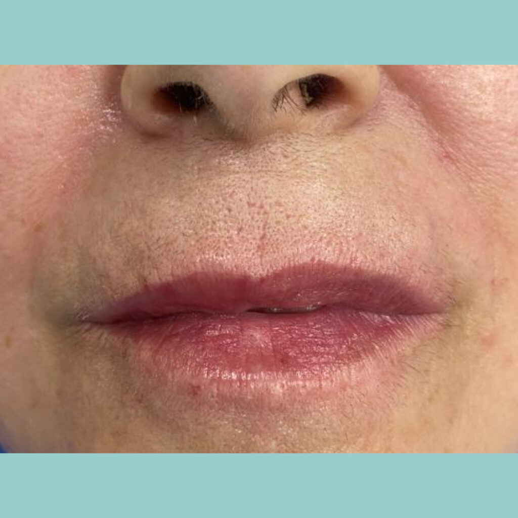 Transformación estética y rejuvenecimiento de la sonrisa · Después