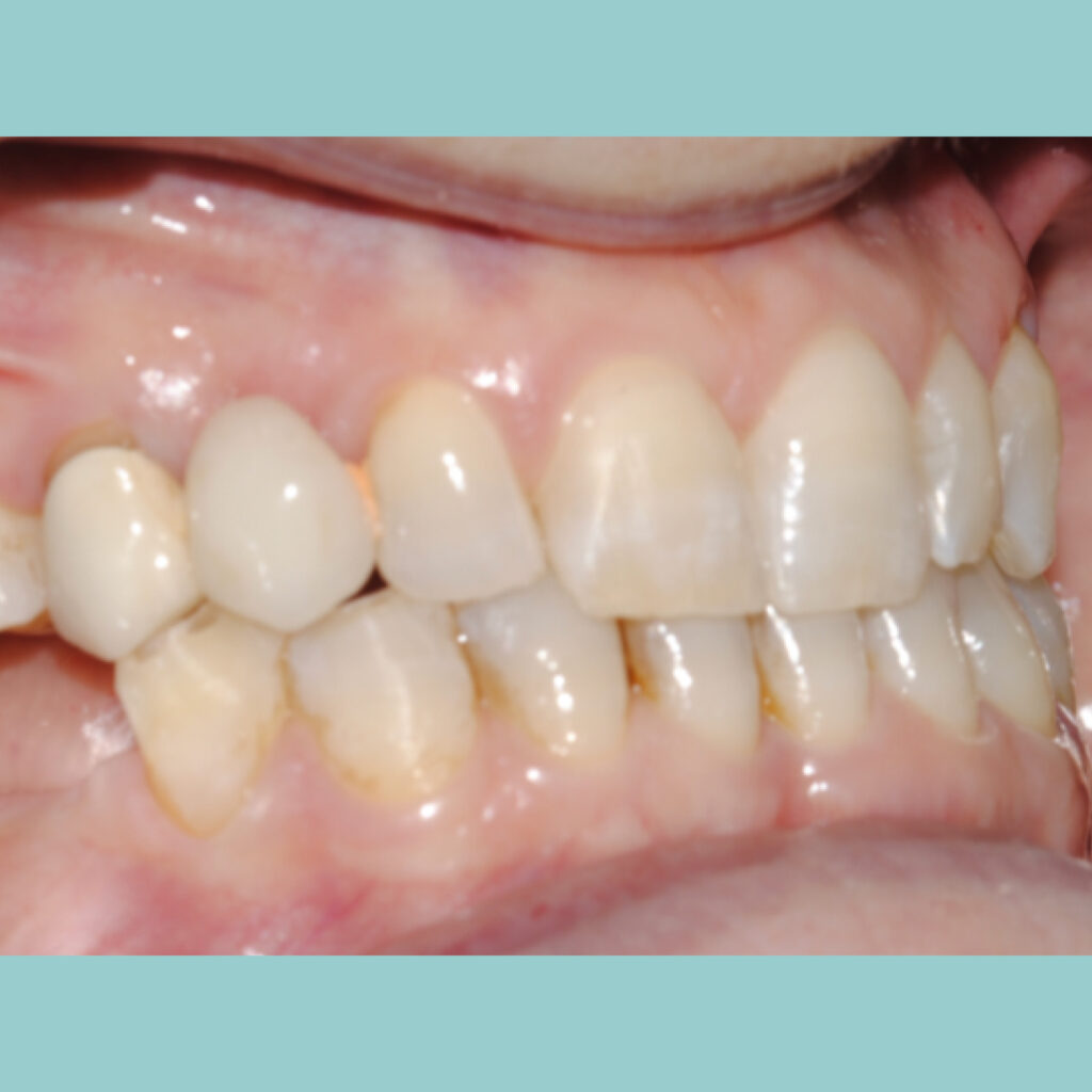 Estética y rehabilitación con implantes mediante cirugía guiada · Antes