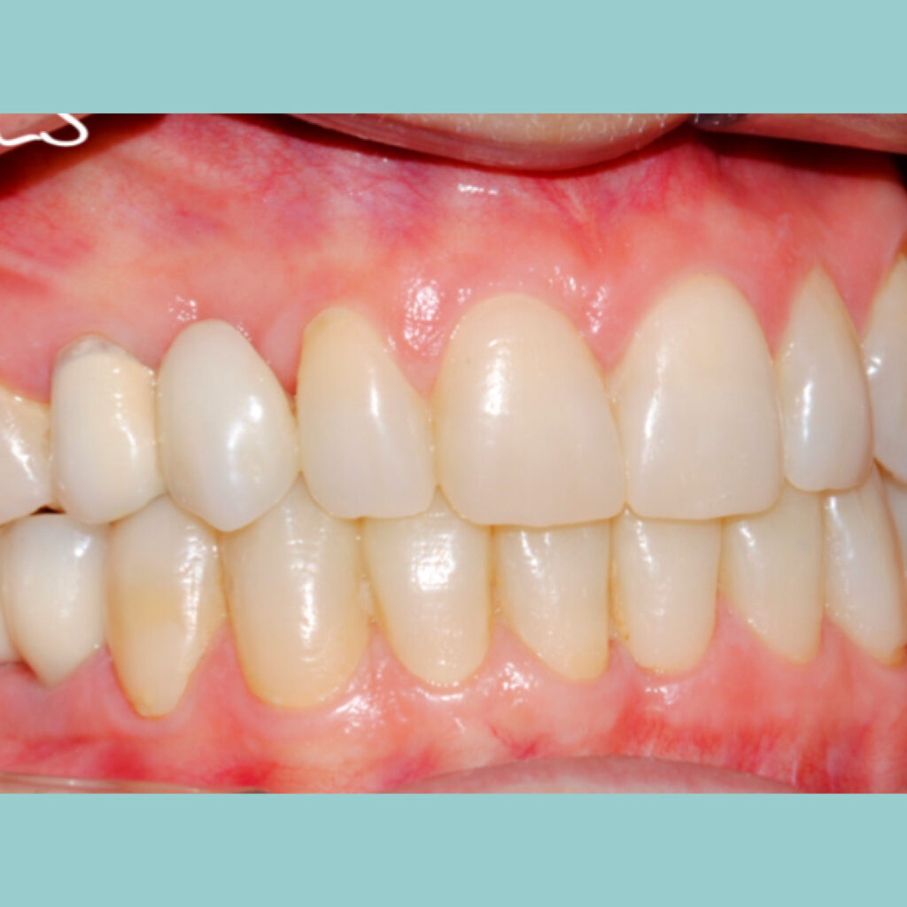 Estética y rehabilitación con implantes mediante cirugía guiada · Después