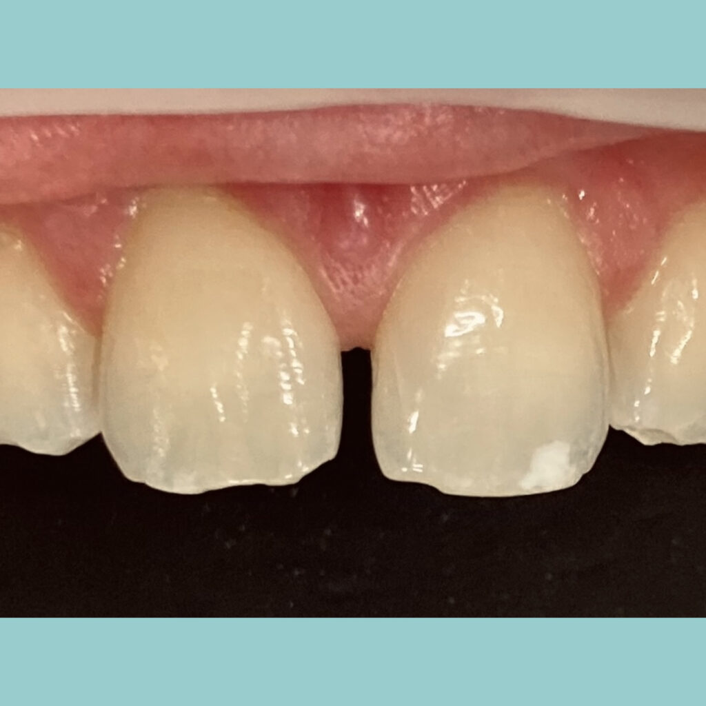 Reconstrucción de bordes incisales · Antes