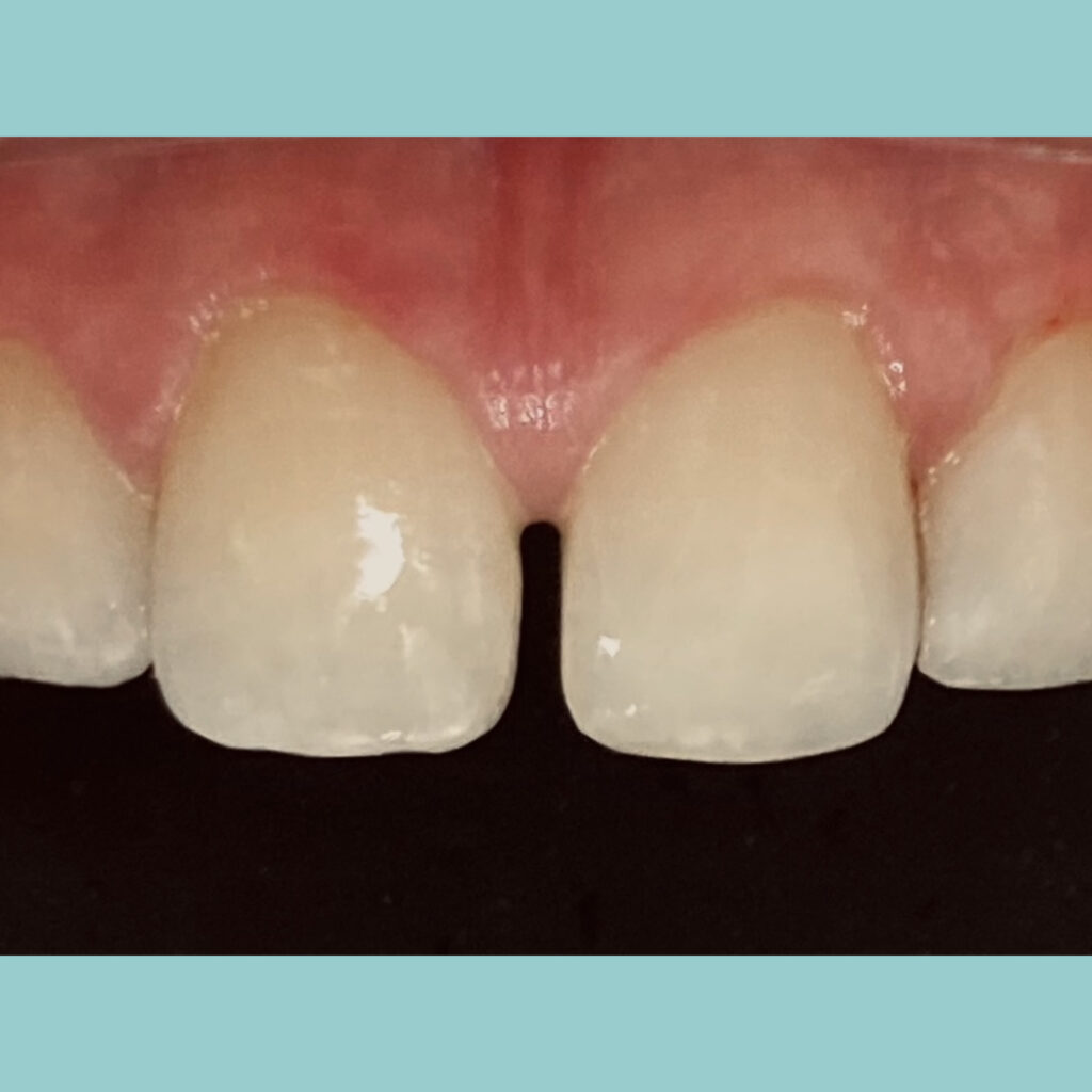 Reconstrucción de bordes incisales · Después