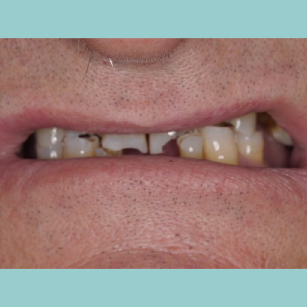 Rehabilitación oral fija de zirconio superior e inferior sobre dientes · Antes