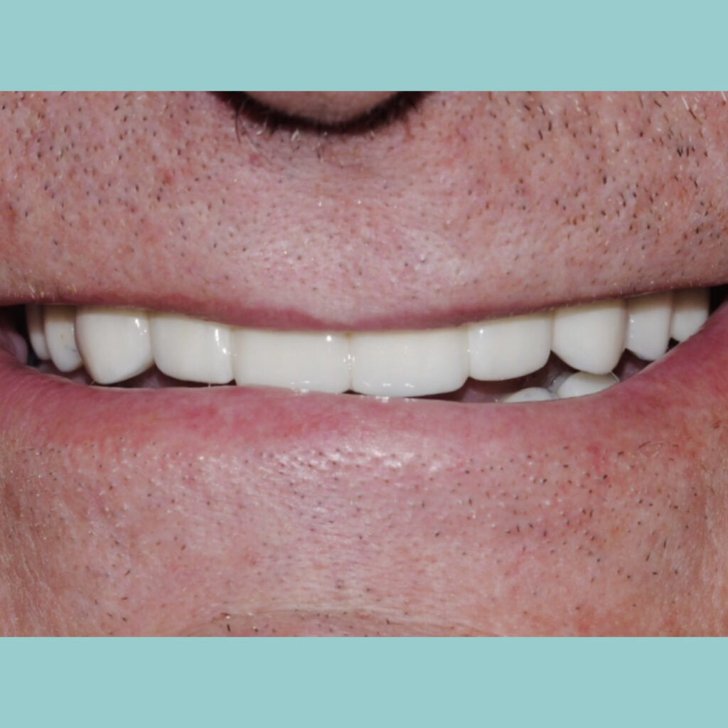 Rehabilitación oral fija de zirconio superior e inferior sobre dientes · Después