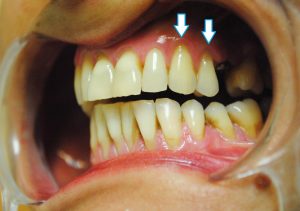 Recesiones de encía con riesgo de pérdida dental · El proceso 1