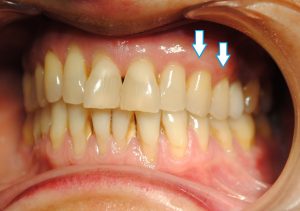Recesiones de encía con riesgo de pérdida dental · El proceso 2