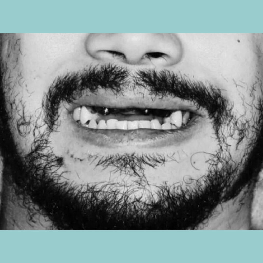 De la pérdida dental a una nueva sonrisa en un solo día con cirugía guiada e impresión 3D · Antes