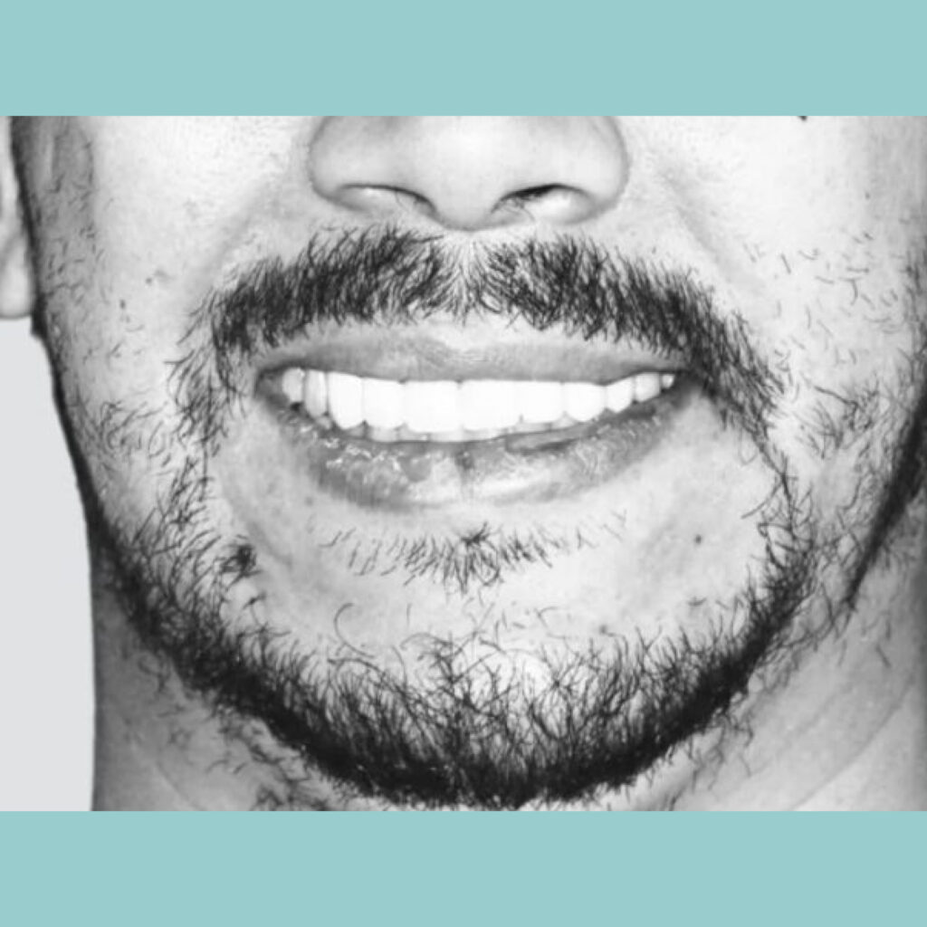 De la pérdida dental a una nueva sonrisa en un solo día con cirugía guiada e impresión 3D · Después