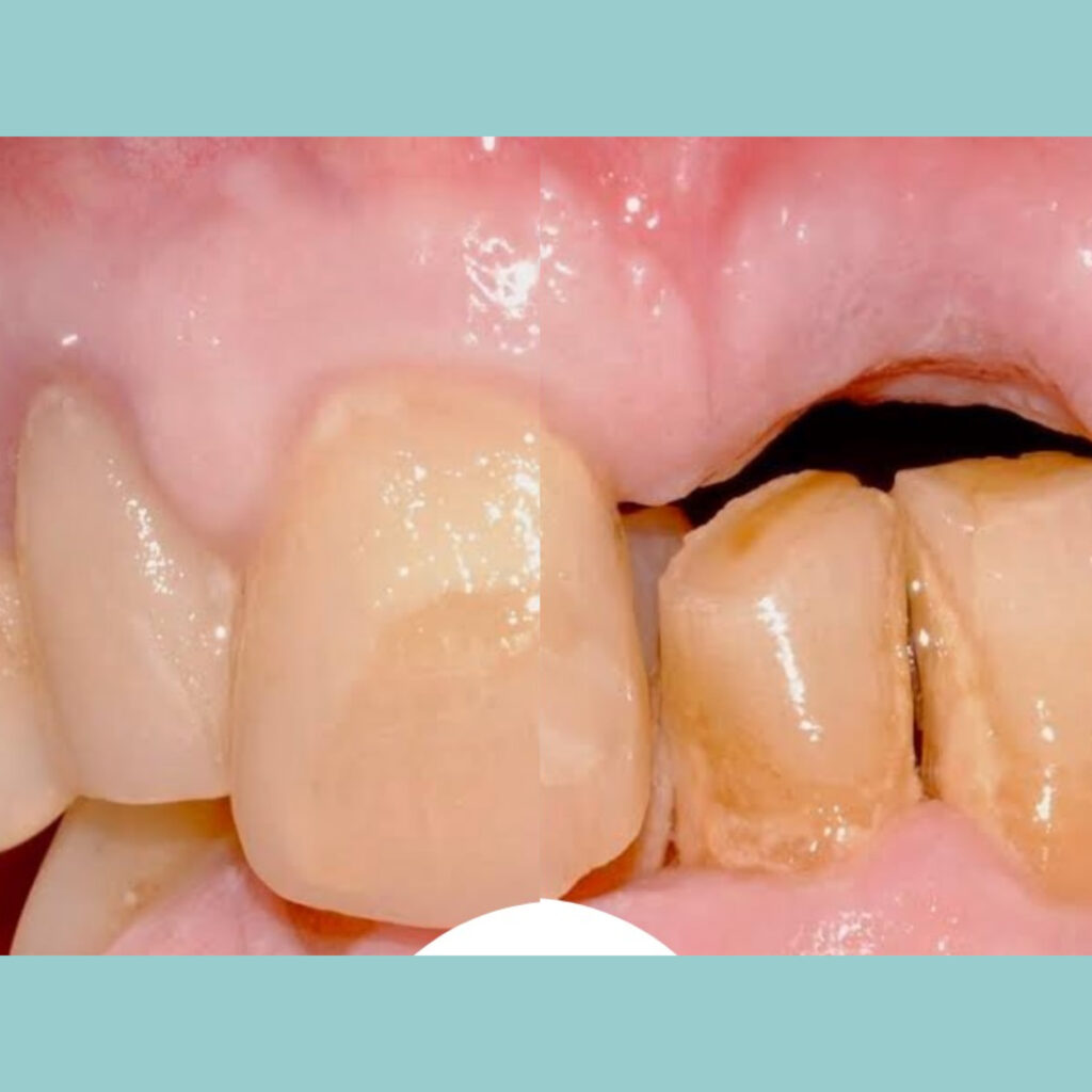 Rehabilitación superior e inferior con implantes · Antes