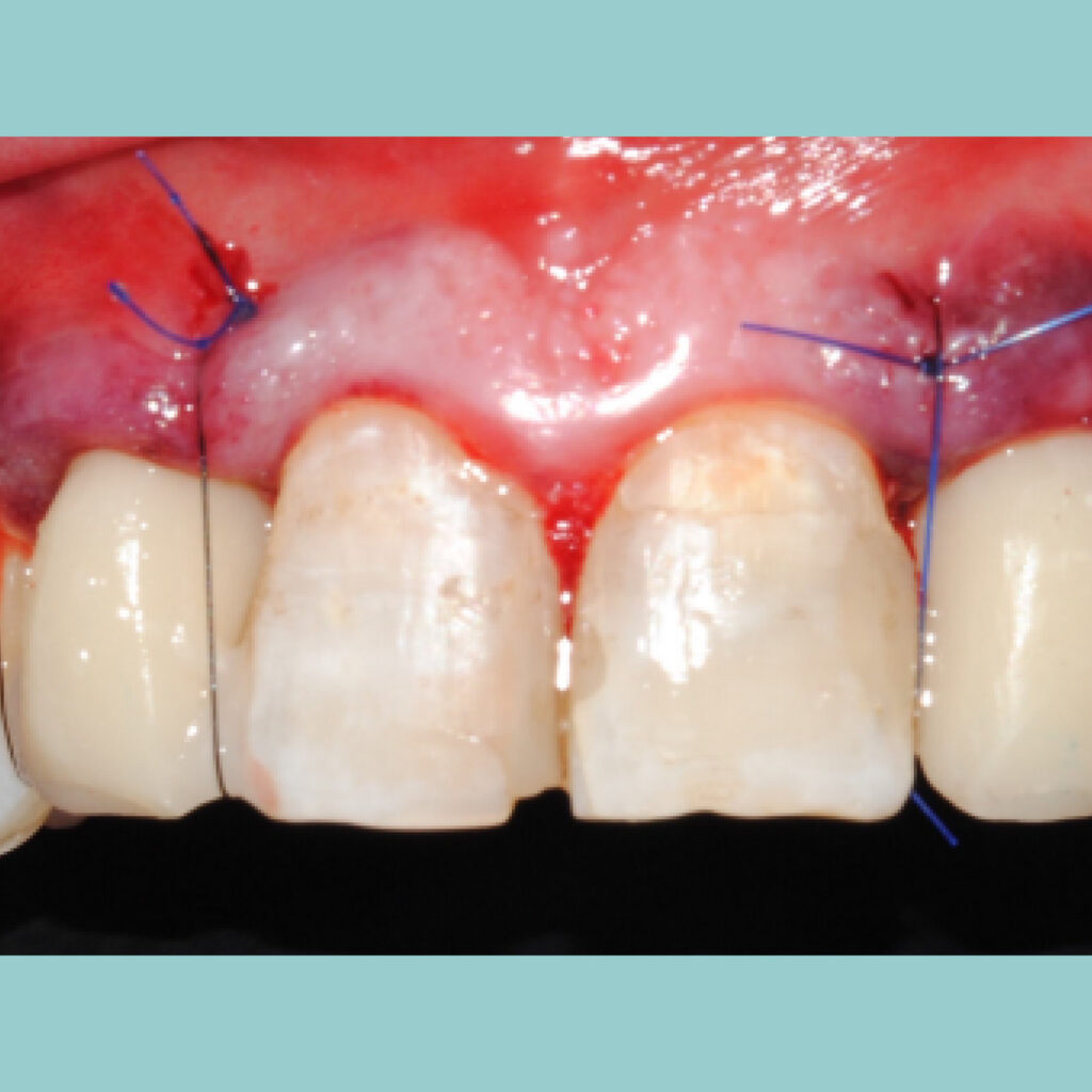 Implantes inmediatos postextracción en posiciones 12 y 22 · Después