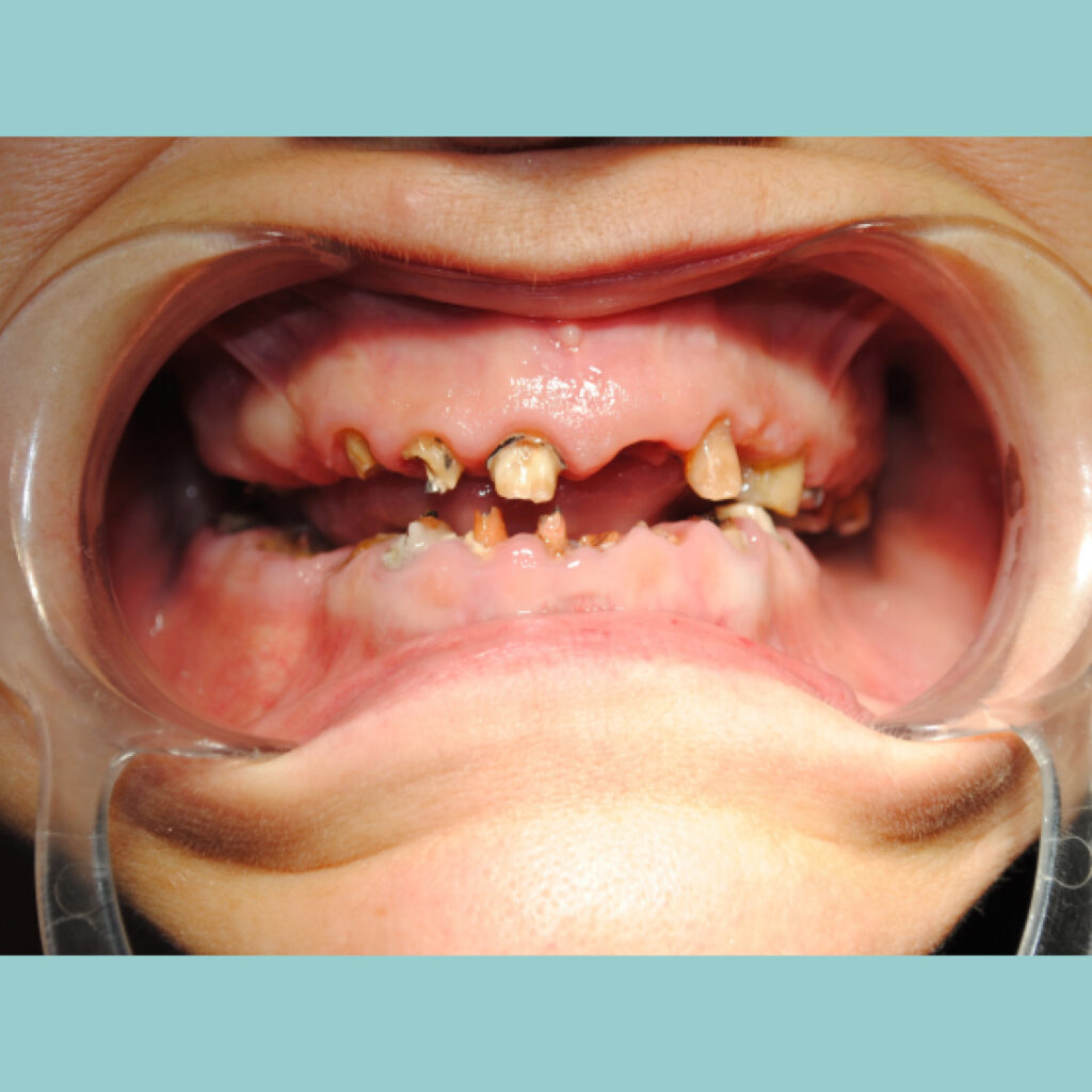 Rehabilitación oral completa con implantes · Antes