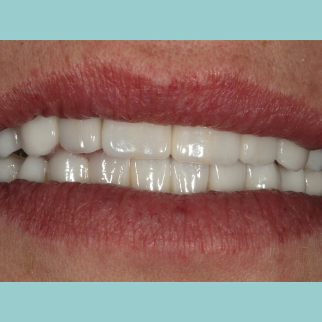 Rehabilitación oral completa con implantes · Después