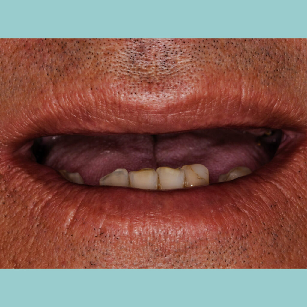 Cirugía guiada: transformación dental en un solo día · Antes