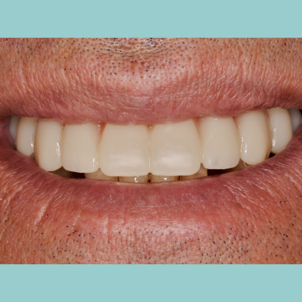 Cirugía guiada: transformación dental en un solo día · Después