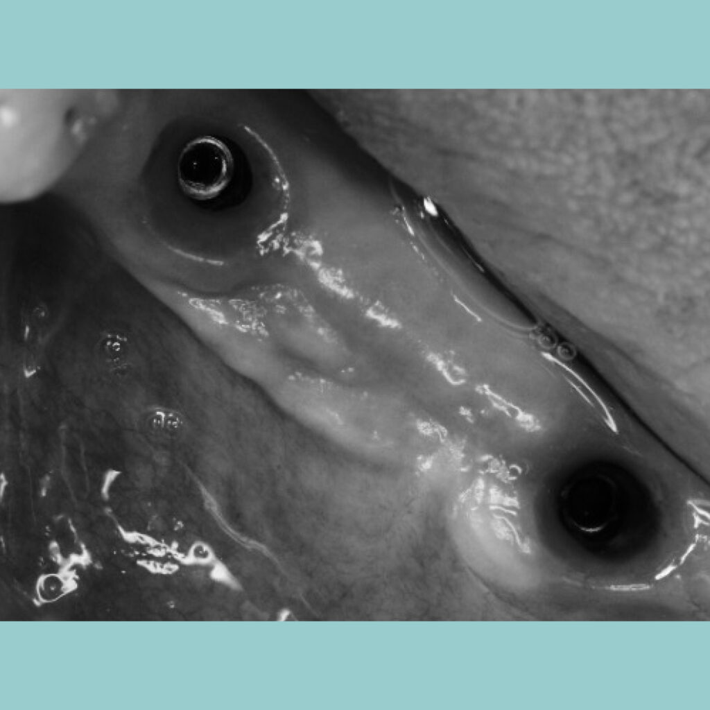Mejora integral con implantes dentales · Antes