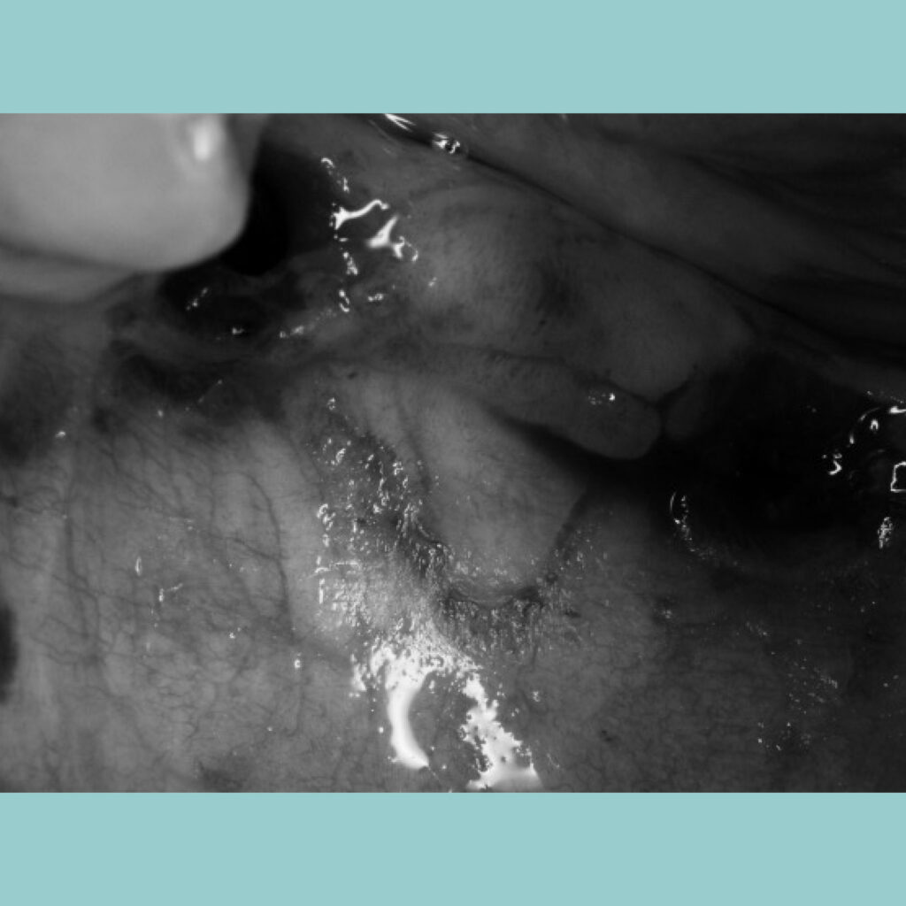 Mejora integral con implantes dentales · Después