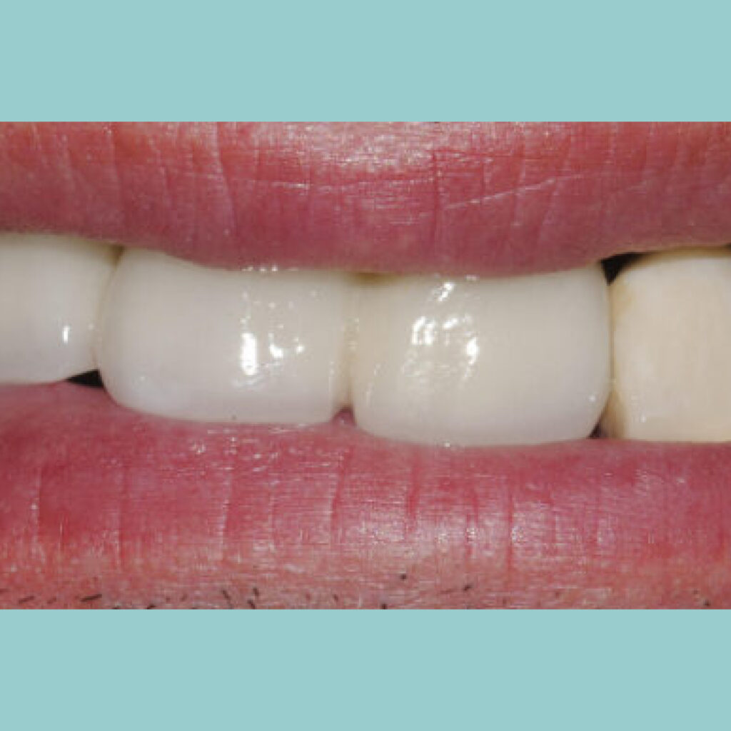 Retirada de dientes con mal pronóstico y colocación de implantes · Antes