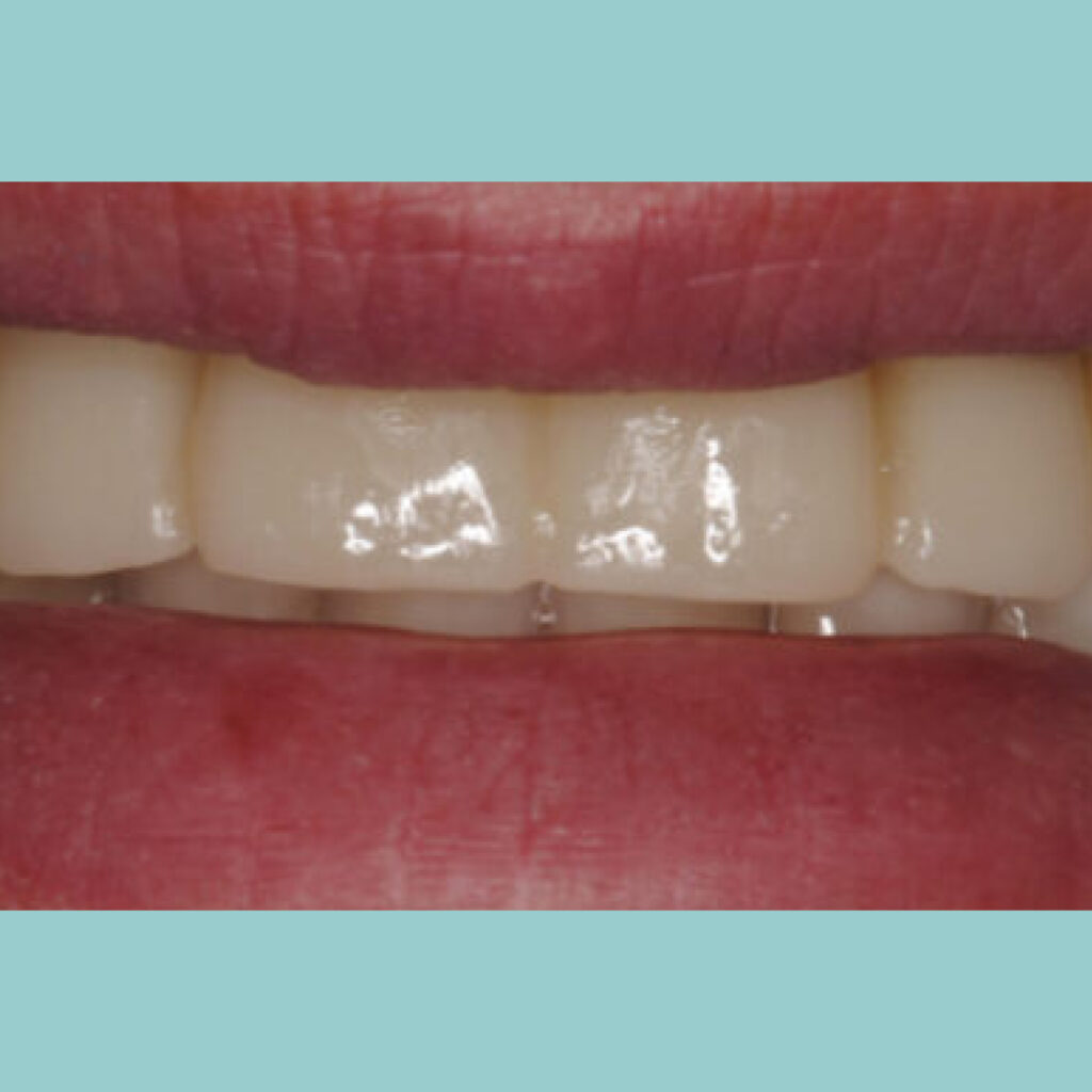 Retirada de dientes con mal pronóstico y colocación de implantes · Después