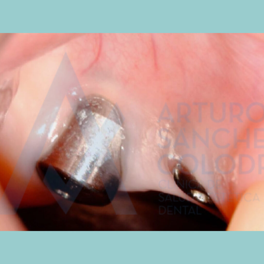 Recesión de encía sobre implantes tratada con injerto gingival libre · Antes