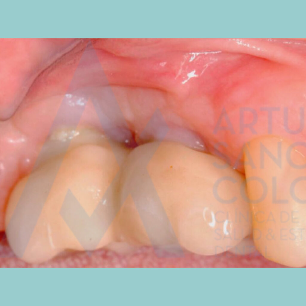Recesión de encía sobre implantes tratada con injerto gingival libre · Después