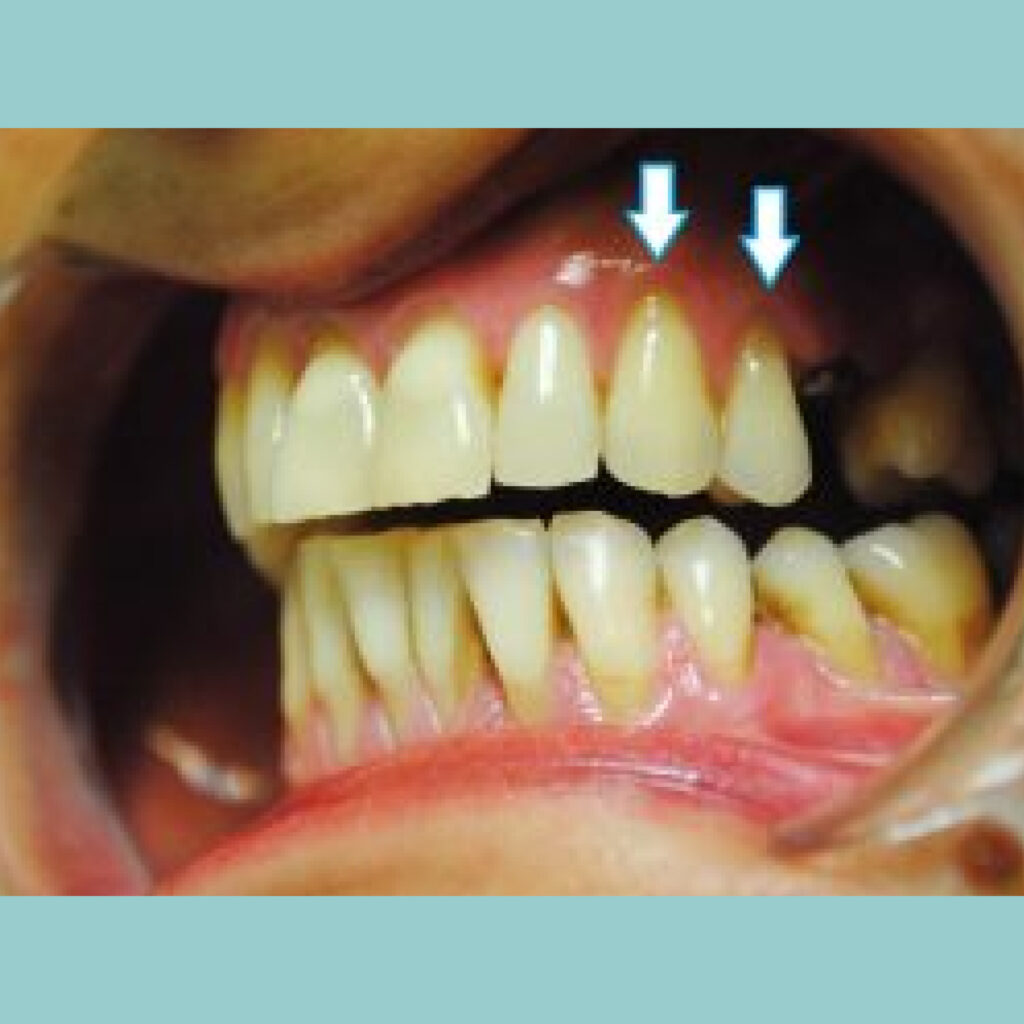 Recesiones de encía con riesgo de pérdida dental · Antes