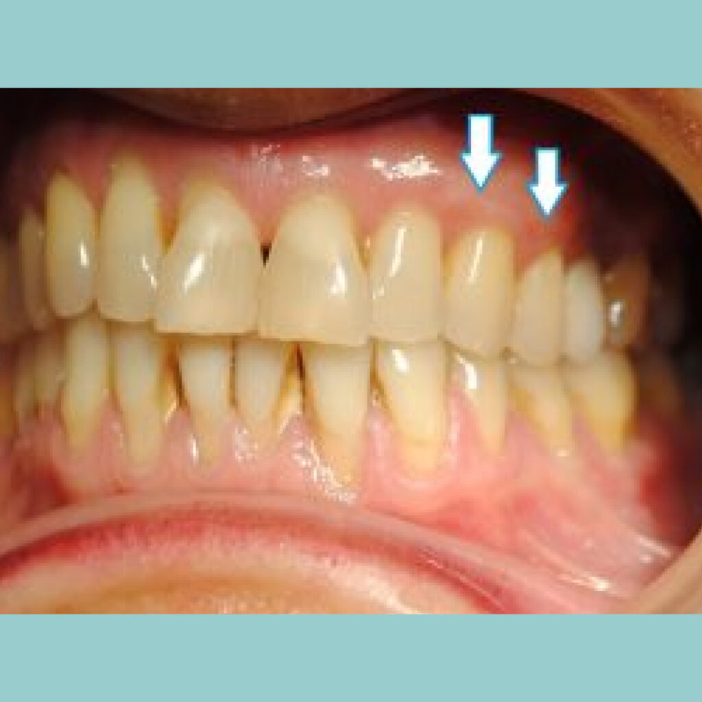 Recesiones de encía con riesgo de pérdida dental · Después