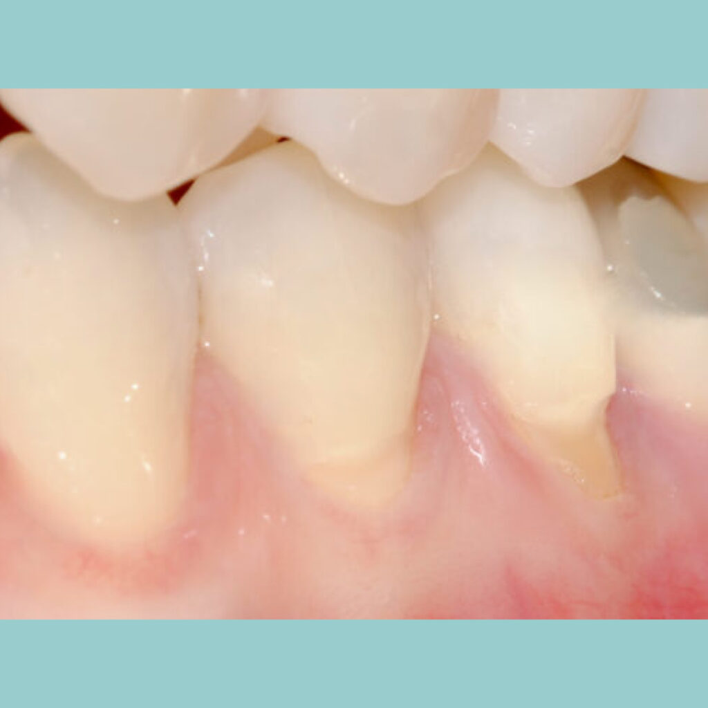 Cirugía mucogingival para restaurar la salud de las encías · Antes