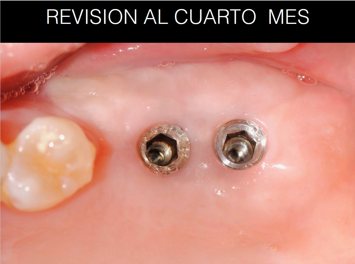 Ausencia de encía queratinizada · El proceso 7