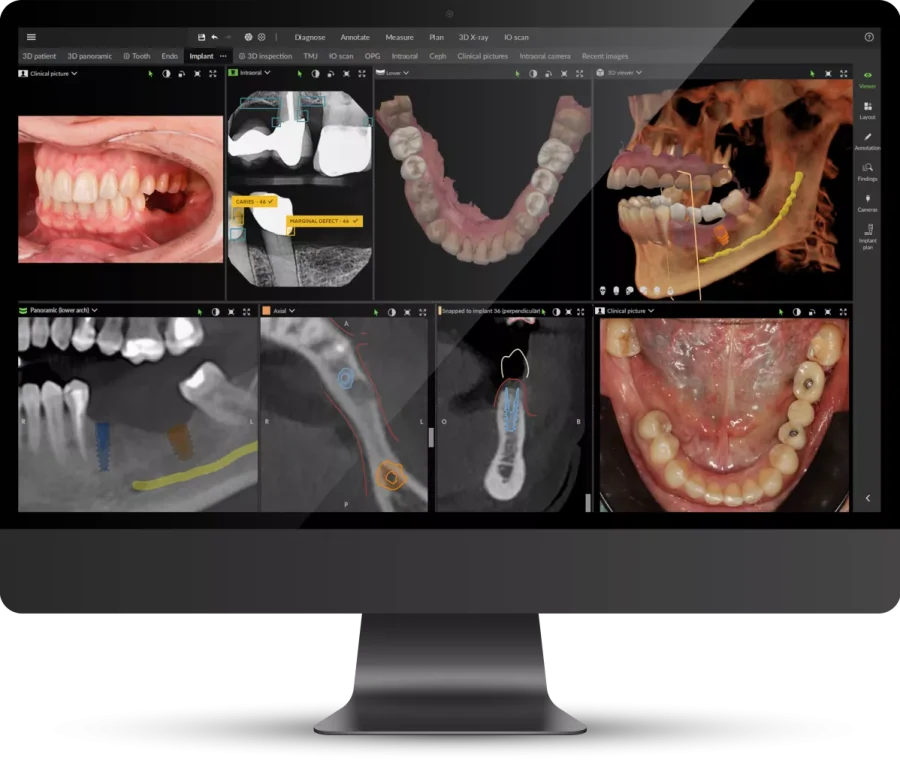 Planificación digital de una cirugía guiada en el ordenador