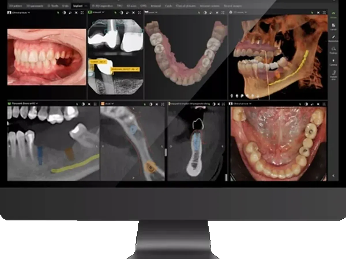 Colocación de implantes dentales con cirugía guiada