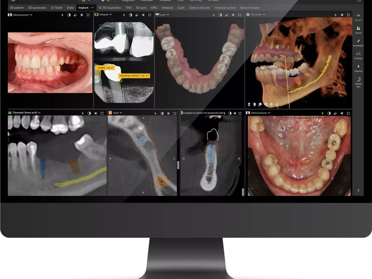 Planificación 3D de una cirugía guiada en el ordenador