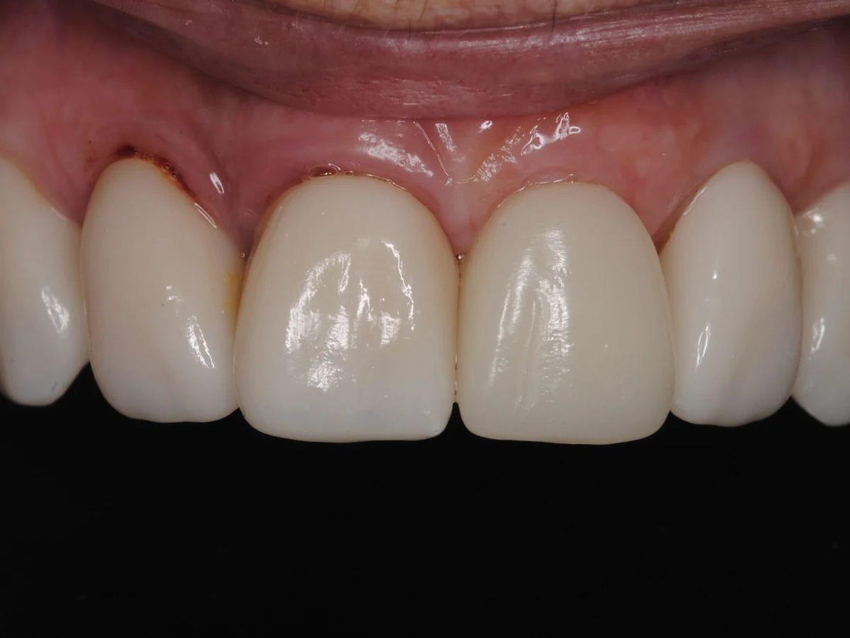 Blanqueamiento dental en Clínica Colodro