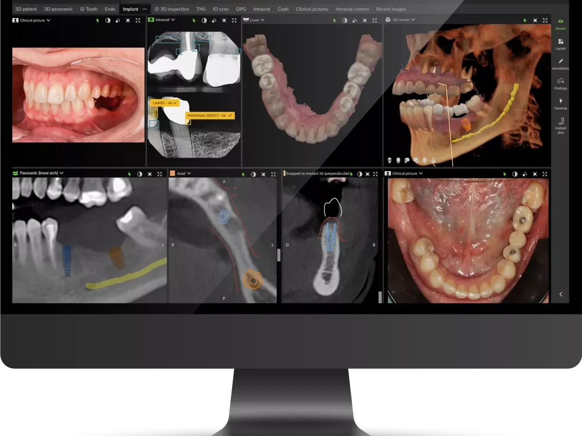 Planificación digital de implantes en la pantalla del ordenador