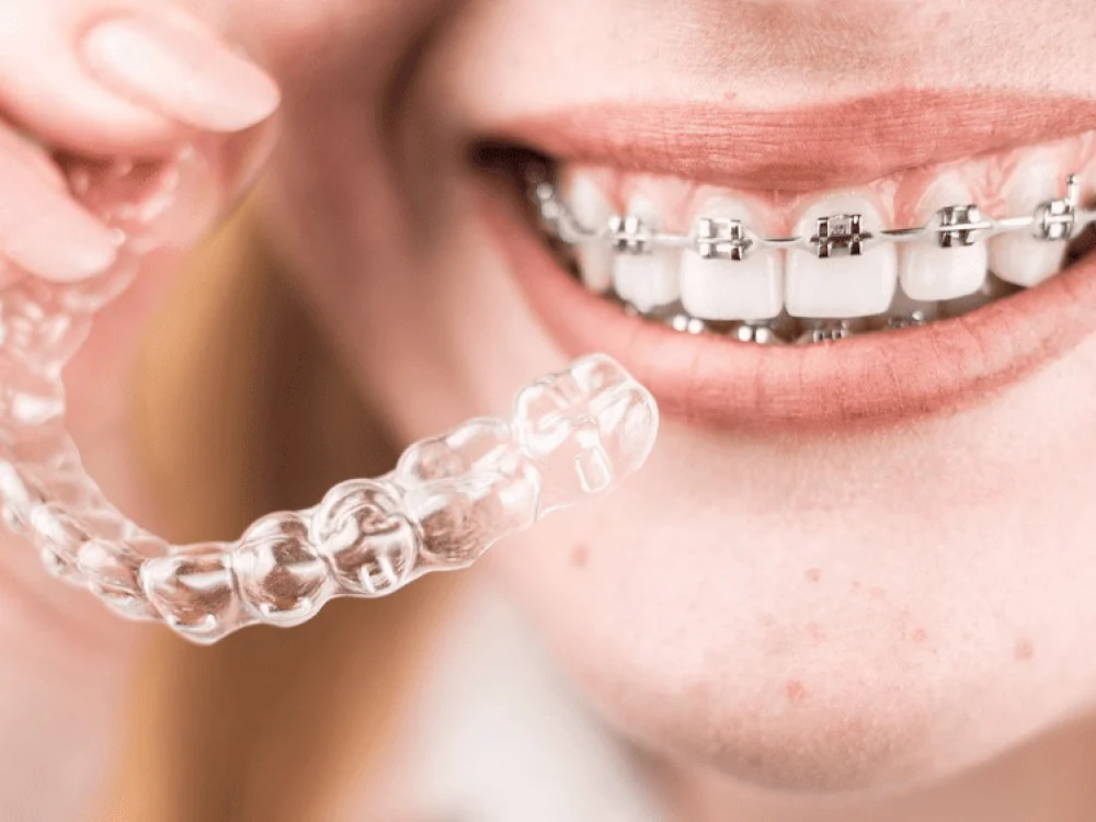 Alineador transparente frente a unos brackets metálicos