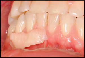 proceso tratamiento 3